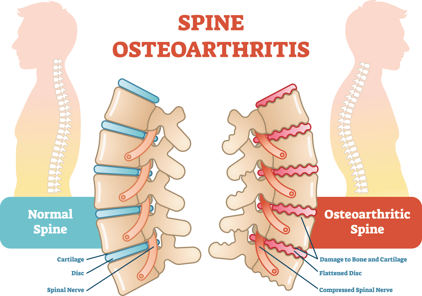 Ostearthritis