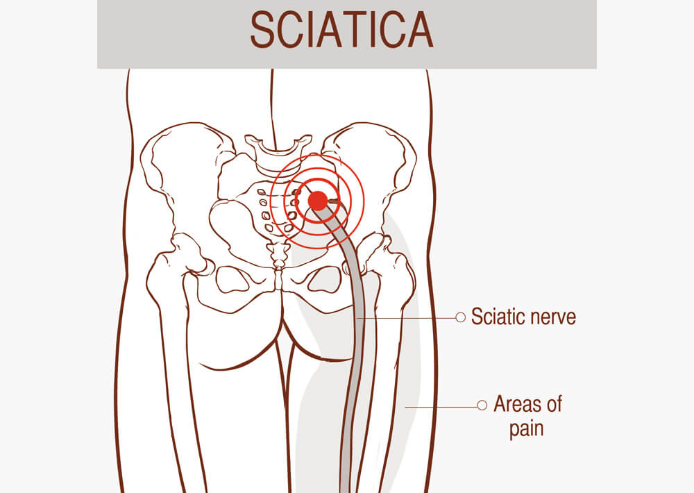 sciatica pain Back Pain Relief Clinic